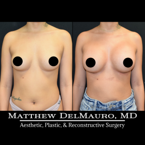 P33-Before-After-1-Months-–-Breast-Augmentation-Silicone2