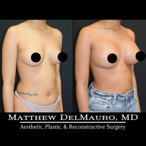 P33-Before-After-1-Months-–-Breast-Augmentation-Silicone3