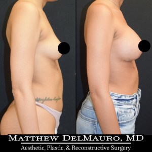 P33-Before-After-1-Months-–-Breast-Augmentation-Silicone4