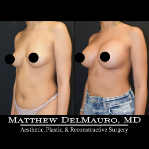 P33-Before-After-1-Months-–-Breast-Augmentation-Silicone5