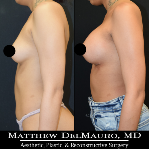 P33-Before-After-1-Months-–-Breast-Augmentation-Silicone6