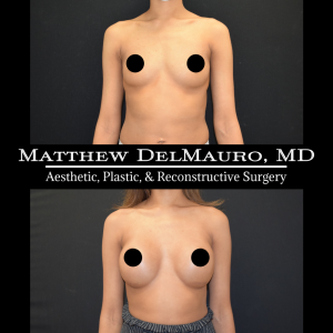 P36-Before-After-1-Years-–-Breast-Augmentation-Silicone1