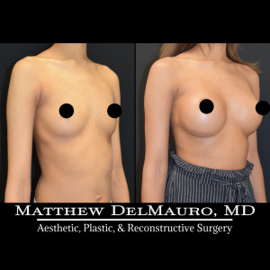 P36-Before-After-1-Years-–-Breast-Augmentation-Silicone2