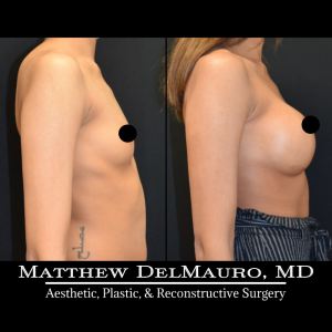 P36-Before-After-1-Years-–-Breast-Augmentation-Silicone3