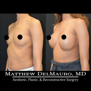 P36-Before-After-1-Years-–-Breast-Augmentation-Silicone4