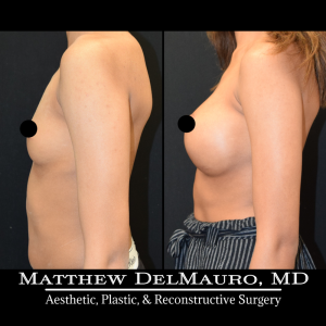 P36-Before-After-1-Years-–-Breast-Augmentation-Silicone5