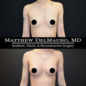 P37-Before-After-3-Months-–-Breast-Augmentation-Silicone1