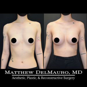 P37-Before-After-3-Months-–-Breast-Augmentation-Silicone2