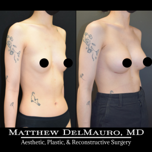 P37-Before-After-3-Months-–-Breast-Augmentation-Silicone3