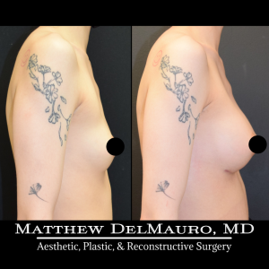 P37-Before-After-3-Months-–-Breast-Augmentation-Silicone4