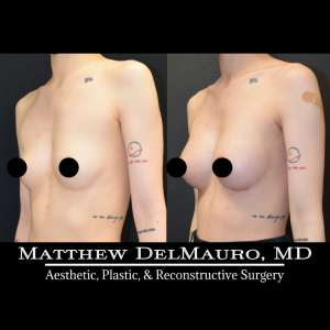 P37-Before-After-3-Months-–-Breast-Augmentation-Silicone5