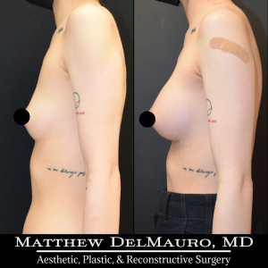 P37-Before-After-3-Months-–-Breast-Augmentation-Silicone6