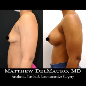 P4-Before-After-3-Months-–-Breast-Augmentation-Silicone