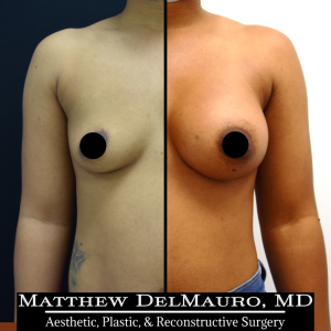 P4-Before-After-3-Months-–-Breast-Augmentation-Silicone1