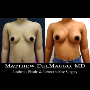 P4-Before-After-3-Months-–-Breast-Augmentation-Silicone2