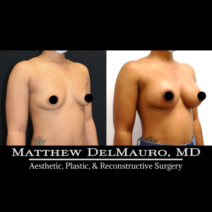 P4-Before-After-3-Months-–-Breast-Augmentation-Silicone3