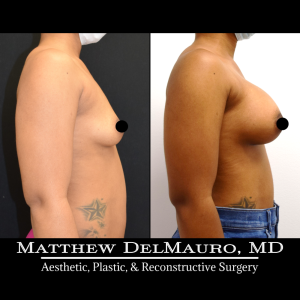 P4-Before-After-3-Months-–-Breast-Augmentation-Silicone4