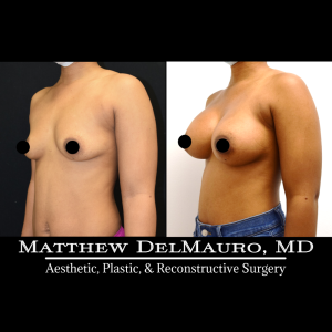 P4-Before-After-3-Months-–-Breast-Augmentation-Silicone5