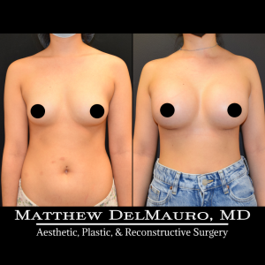 P42-Before-After-4-Months-–-Breast-Augmentation-Silicone2