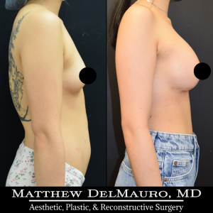 P42-Before-After-4-Months-–-Breast-Augmentation-Silicone3