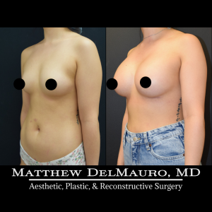 P42-Before-After-4-Months-–-Breast-Augmentation-Silicone4