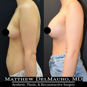 P42-Before-After-4-Months-–-Breast-Augmentation-Silicone5