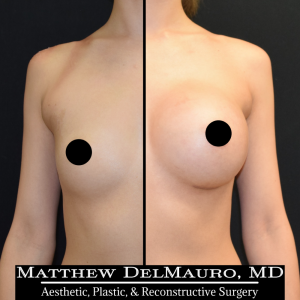 P45-Before-After-1-Years-–-Breast-Augmentation-Silicone1