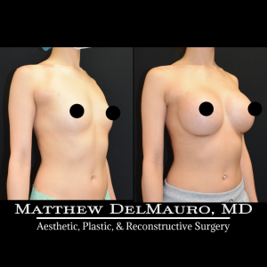 P45-Before-After-1-Years-–-Breast-Augmentation-Silicone3