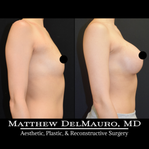 P45-Before-After-1-Years-–-Breast-Augmentation-Silicone4