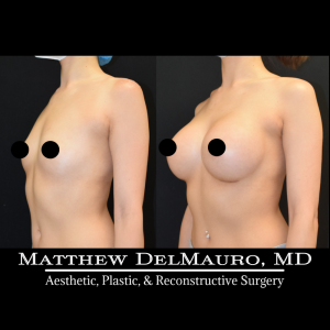 P45-Before-After-1-Years-–-Breast-Augmentation-Silicone5