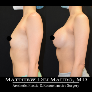 P45-Before-After-1-Years-–-Breast-Augmentation-Silicone6