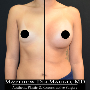 P49-Before-After-1-Months-–-Breast-Augmentation-Silicone1