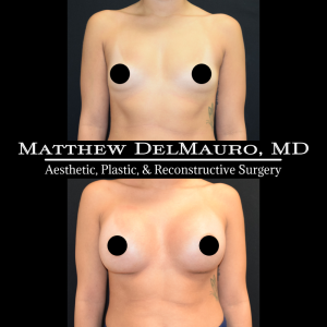 P49-Before-After-1-Months-–-Breast-Augmentation-Silicone2