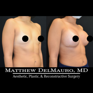 P49-Before-After-1-Months-–-Breast-Augmentation-Silicone3