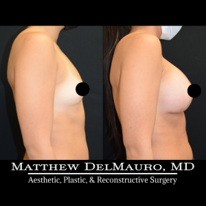 P49-Before-After-1-Months-–-Breast-Augmentation-Silicone4