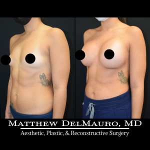 P49-Before-After-1-Months-–-Breast-Augmentation-Silicone5