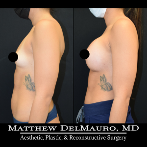 P49-Before-After-1-Months-–-Breast-Augmentation-Silicone6