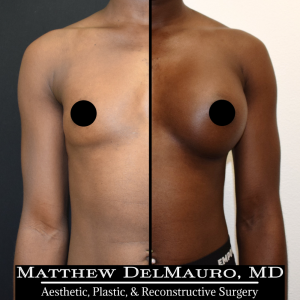 P54-Before-After-1-Years-–-Breast-Augmentation-Silicone1