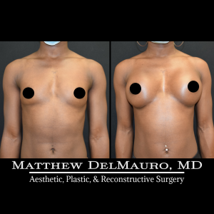 P54-Before-After-1-Years-4-Months-–-Breast-Augmentation-Silicone1