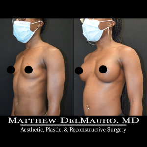 P54-Before-After-1-Years-4-Months-–-Breast-Augmentation-Silicone2