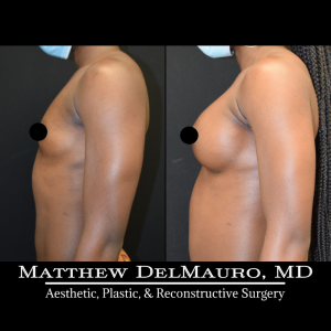 P54-Before-After-1-Years-4-Months-–-Breast-Augmentation-Silicone3