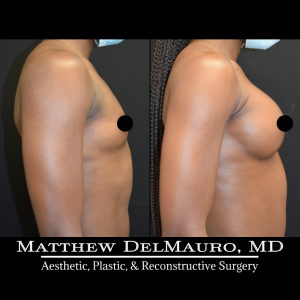 P54-Before-After-1-Years-4-Months-–-Breast-Augmentation-Silicone4