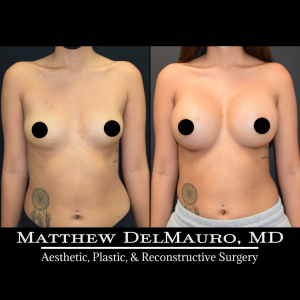 P60-Before-After-4-Months-–-Breast-Augmentation-Silicone1