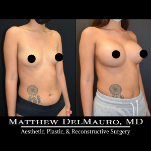 P60-Before-After-4-Months-–-Breast-Augmentation-Silicone2