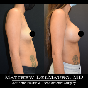 P60-Before-After-4-Months-–-Breast-Augmentation-Silicone3