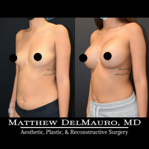 P60-Before-After-4-Months-–-Breast-Augmentation-Silicone4