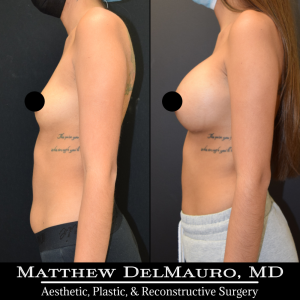 P60-Before-After-4-Months-–-Breast-Augmentation-Silicone5