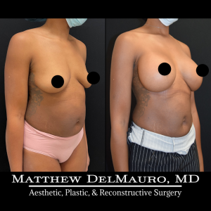 P61-Before-After-4-Months-–-Breast-Augmentation-Silicone1