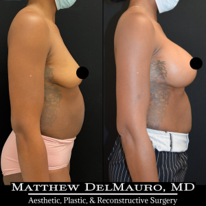 P61-Before-After-4-Months-–-Breast-Augmentation-Silicone2