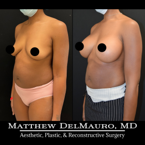 P61-Before-After-4-Months-–-Breast-Augmentation-Silicone3